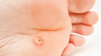 Ayak Nasırı: Göz ardı edilmemesi gereken bir sağlık sorunu!