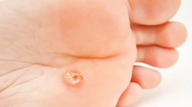 Ayak Nasırı: Göz ardı edilmemesi gereken bir sağlık sorunu!