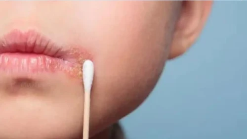 “Uçukla Mücadelede Şaşırtan Çözüm: Vazelin ve Buzla Hızlı Tedavi”