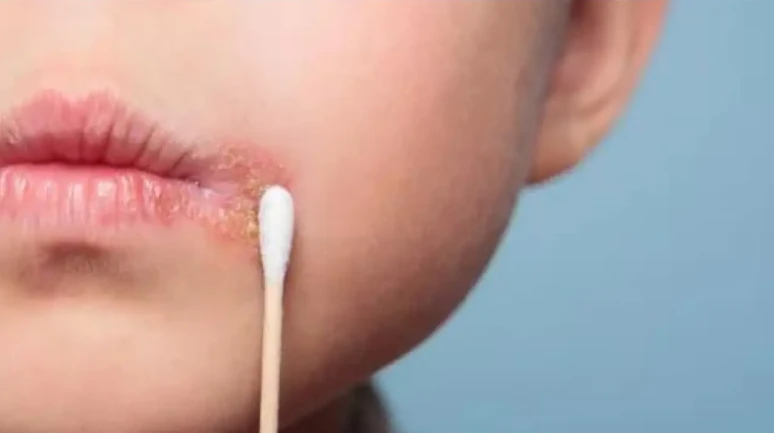 “Uçukla Mücadelede Şaşırtan Çözüm: Vazelin ve Buzla Hızlı Tedavi”